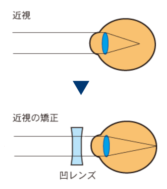 近視の矯正についての画像