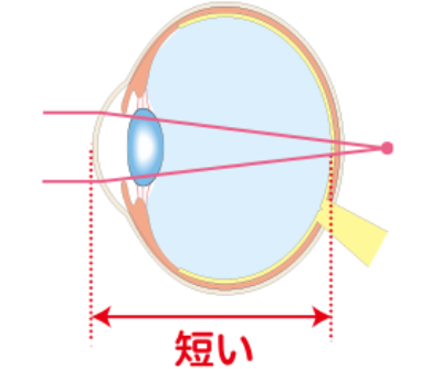 遠視