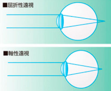 遠視とは